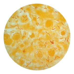 English: Photomicrograph of a sputum sample co... English: Photomicrograph of a sputum sample co...