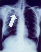 Tuberculosis creates cavities visible in x-ray... Tuberculosis creates cavities visible in x-ray...